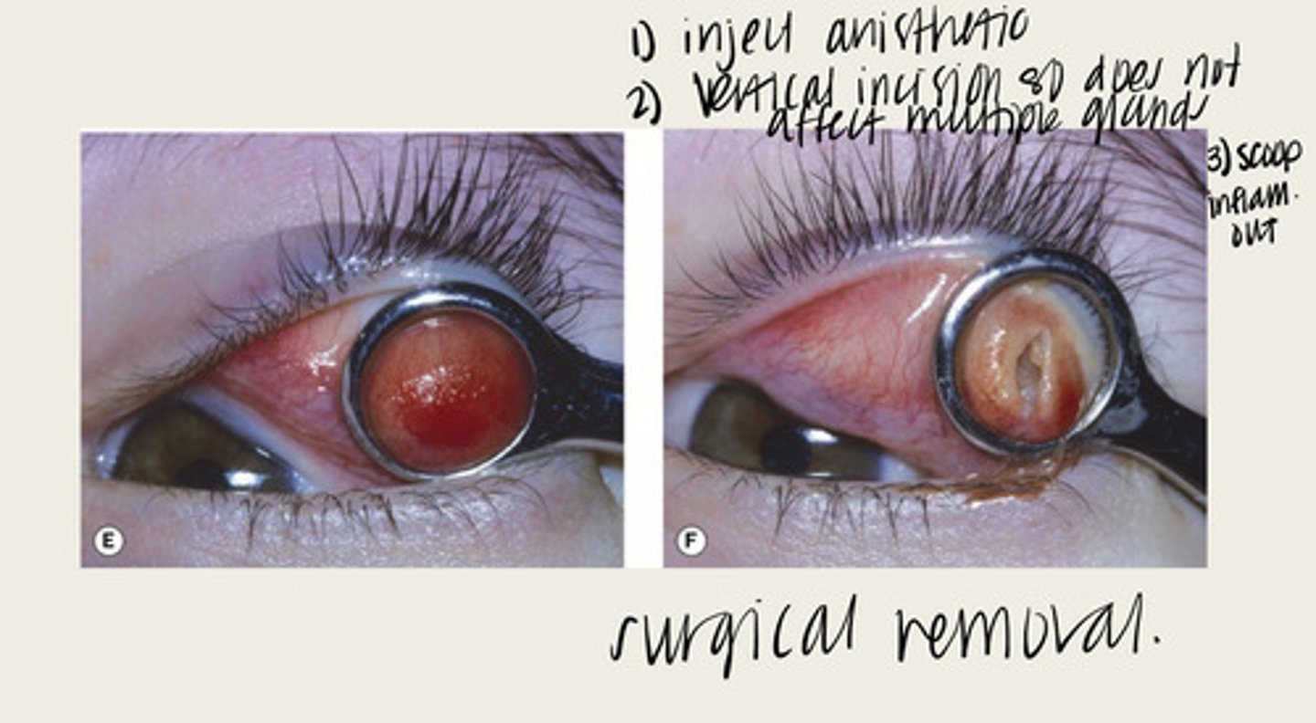 <p>What is the treatment for chalazion?</p>