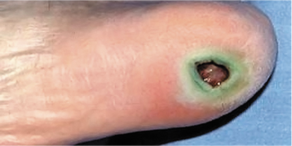 <p>this greenish lesion is caused by a bacterial virulence factor called ___.</p>