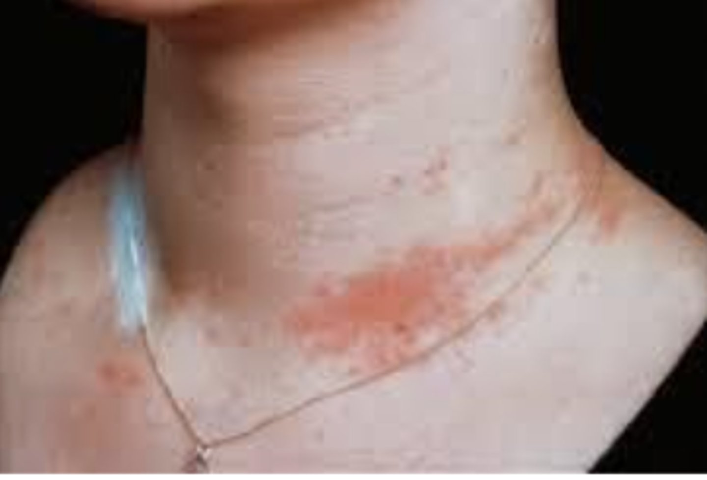 <p>any inflammation of the skin (contact Dermatitis)</p>