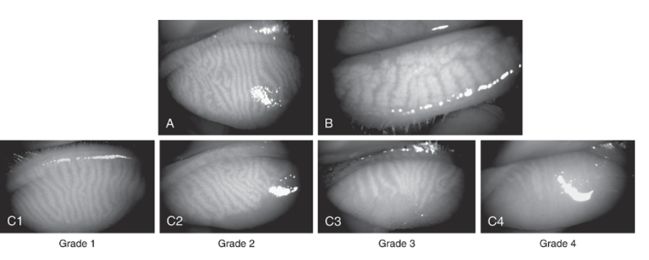 <p>produces and secretes meibum </p><p>plays role in maintaining the health of the eyes tear film and prpeventing dry eye </p><p>in picture grade 4 shows no glands visible so likely person suffers from dry eye </p>