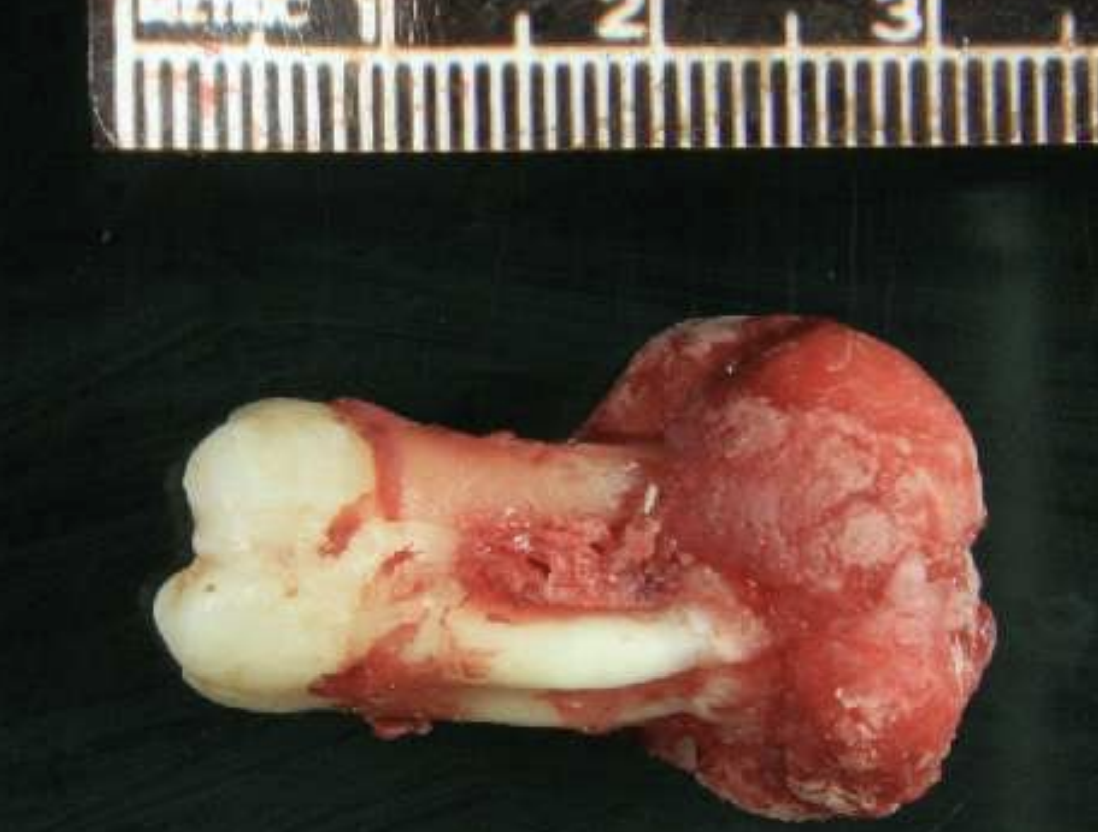 <p>cementoblastoma</p>