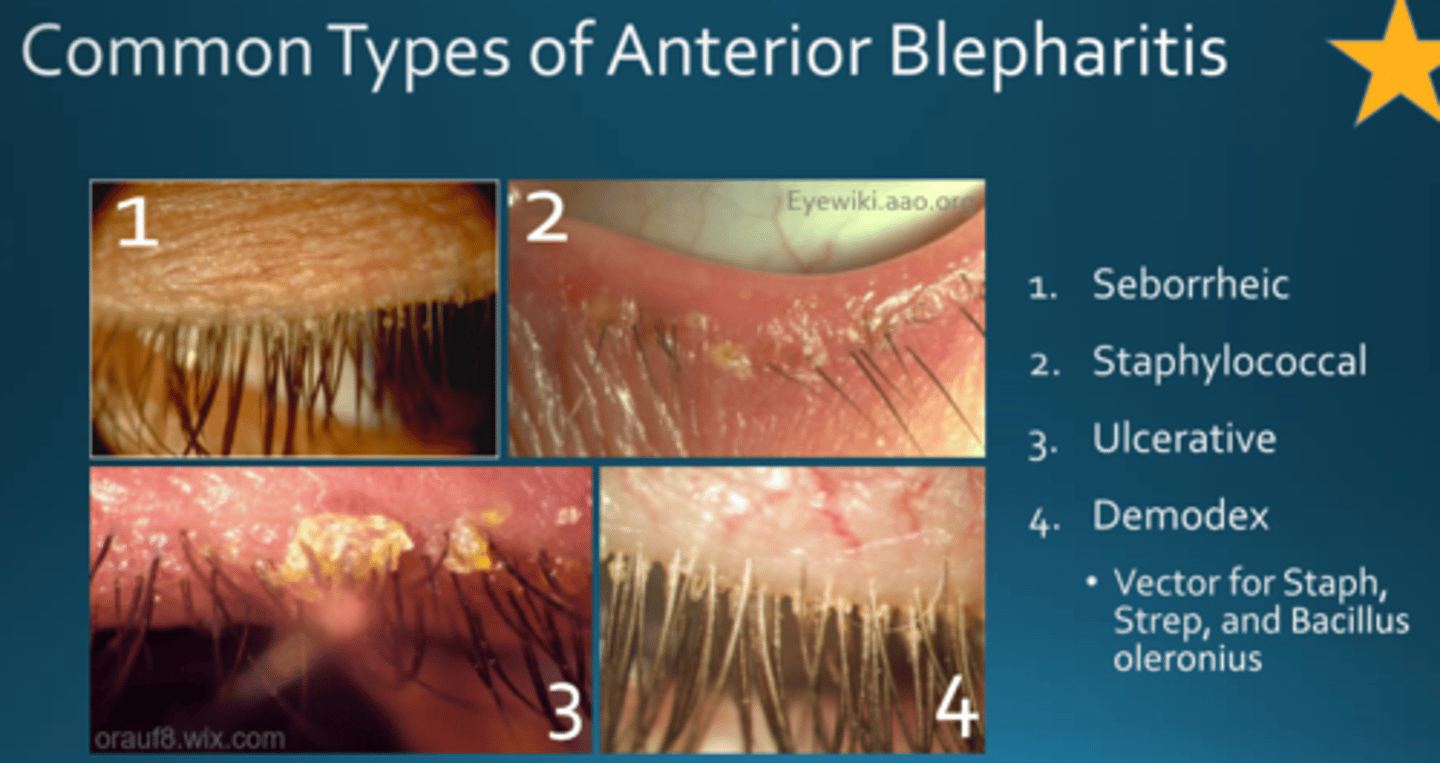 <p>1) Seborrheic</p><p>2) Staphylococcal</p><p>3) Ulcerative</p><p>4) Demodex</p><p>- Vector for staph, strep, and Bacillus oleronius</p>
