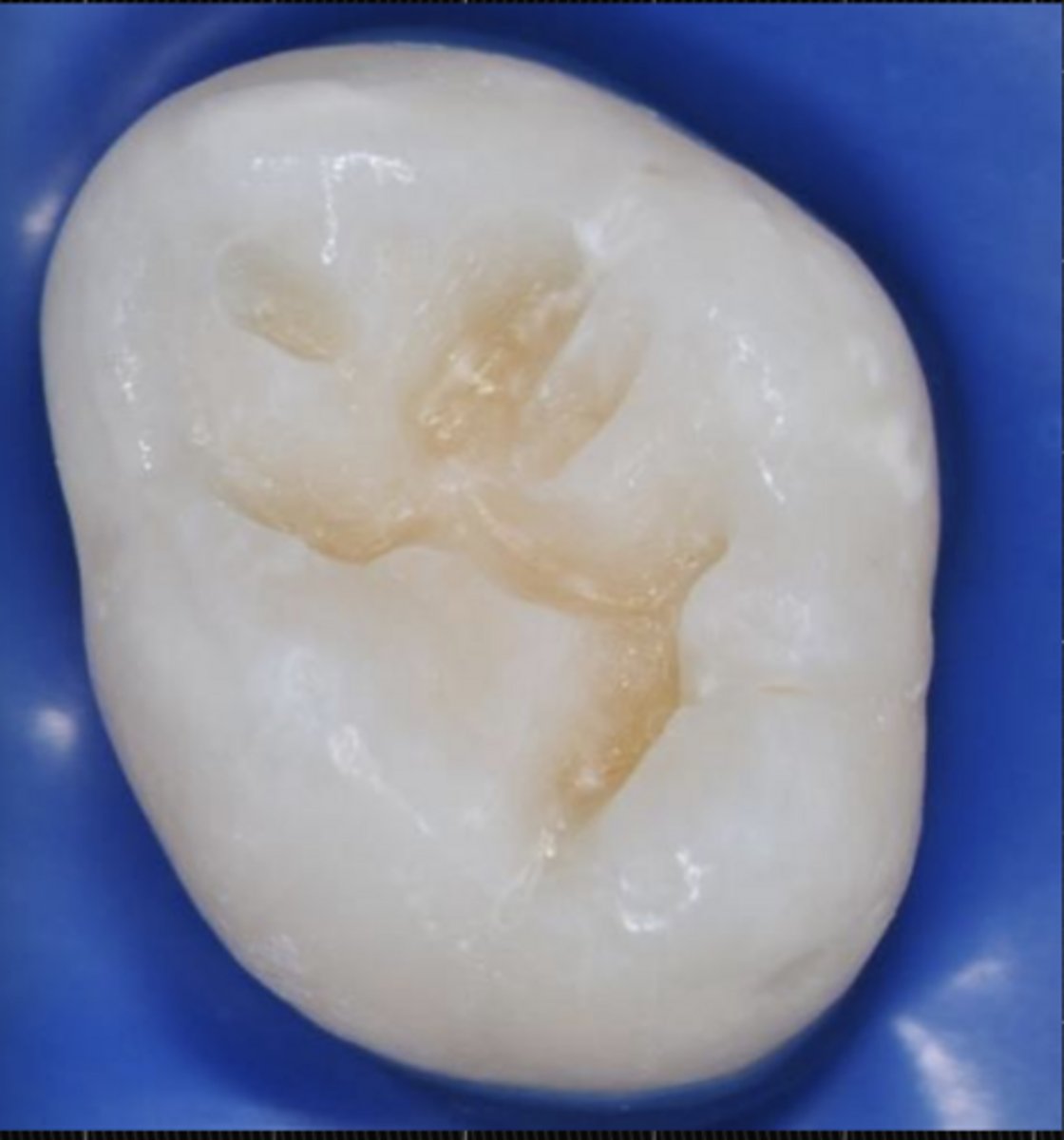 <p>A pushing force needs to be used with a hard instrument to engage the dentin, and only a sharp cutting edge or a bur will lift it. A scratchy sound or "cri dentinaire" can be heard when a straight probe is taken across the dentin</p>