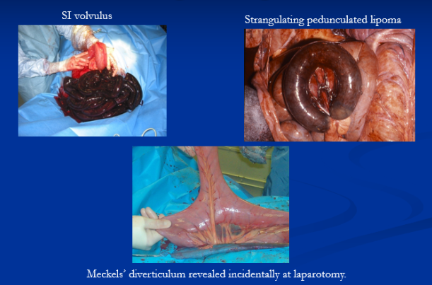 <ul><li><p>Abd. pain, Nasogastric reflux, SI distention </p></li><li><p><span style="background-color: transparent;"><strong>Simple Intraluminal </strong></span></p><ul><li><p><span style="background-color: transparent; color: red;"><strong>Ascarid: </strong>foals (post-deworming </span><span style="background-color: transparent;">heavy burden)</span></p></li><li><p><span style="background-color: transparent;"><strong>Ilea: </strong>Bermuda hay & tapeworms</span></p></li><li><p><span style="background-color: transparent;"><strong>FB: </strong>baling twine, plastic</span></p></li></ul></li><li><p><span style="background-color: transparent;"><strong>Strangulating</strong></span></p><ul><li><p><span style="background-color: transparent; color: red;"><strong>Pedunculated lipoma</strong></span><span style="background-color: transparent;"><strong>: </strong>old, overweight horses</span></p></li><li><p><span style="background-color: transparent;"><strong>SI volvulus: </strong>all ages</span></p></li></ul></li><li><p><span style="background-color: transparent;"><strong>Meckel’s diverticulum complications</strong></span></p><ul><li><p><span style="background-color: transparent;"><strong>Cs: </strong>Abdominal pain</span></p></li><li><p><span style="background-color: transparent;"><strong>Dt:</strong> Enterogastric reflux (NG tube), imaging w/ distended loops</span></p></li><li><p><span style="background-color: transparent;"><strong>Tx: </strong>Sx emerg</span></p></li></ul></li></ul><p></p>