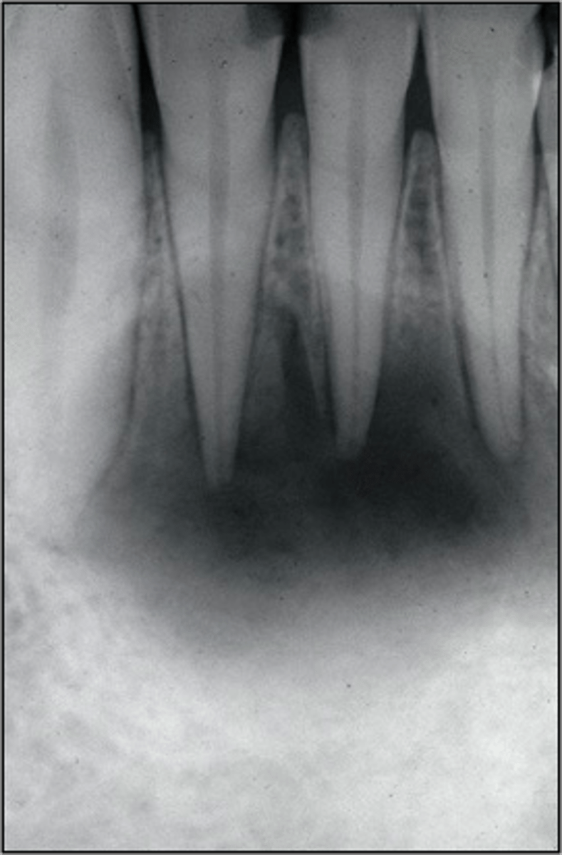 <p>What is the treatment for a lesion that has <strong>walled itself off from body's defenses</strong>?</p><p>- Biofilms, Cysts</p><p>- Resistant bacteria (Actinomycosis (sulfur granules))</p>
