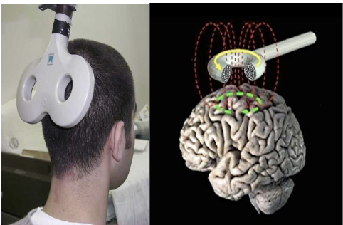 <p>Transcranial Magnetic Stimulation (TMS)</p>