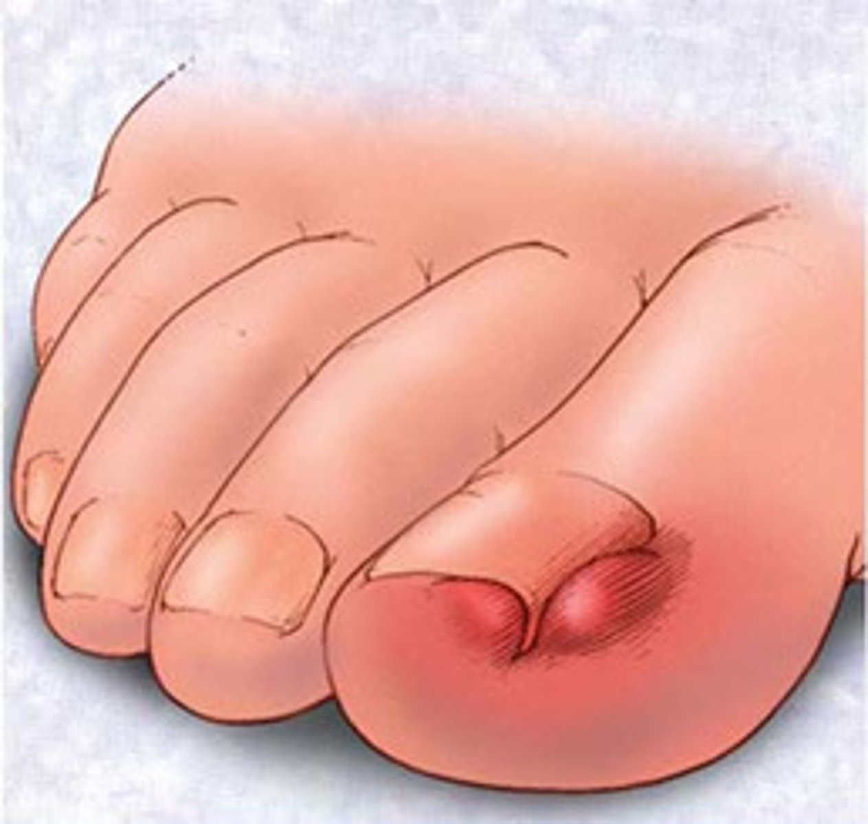 <p>Ingrown toenail</p>