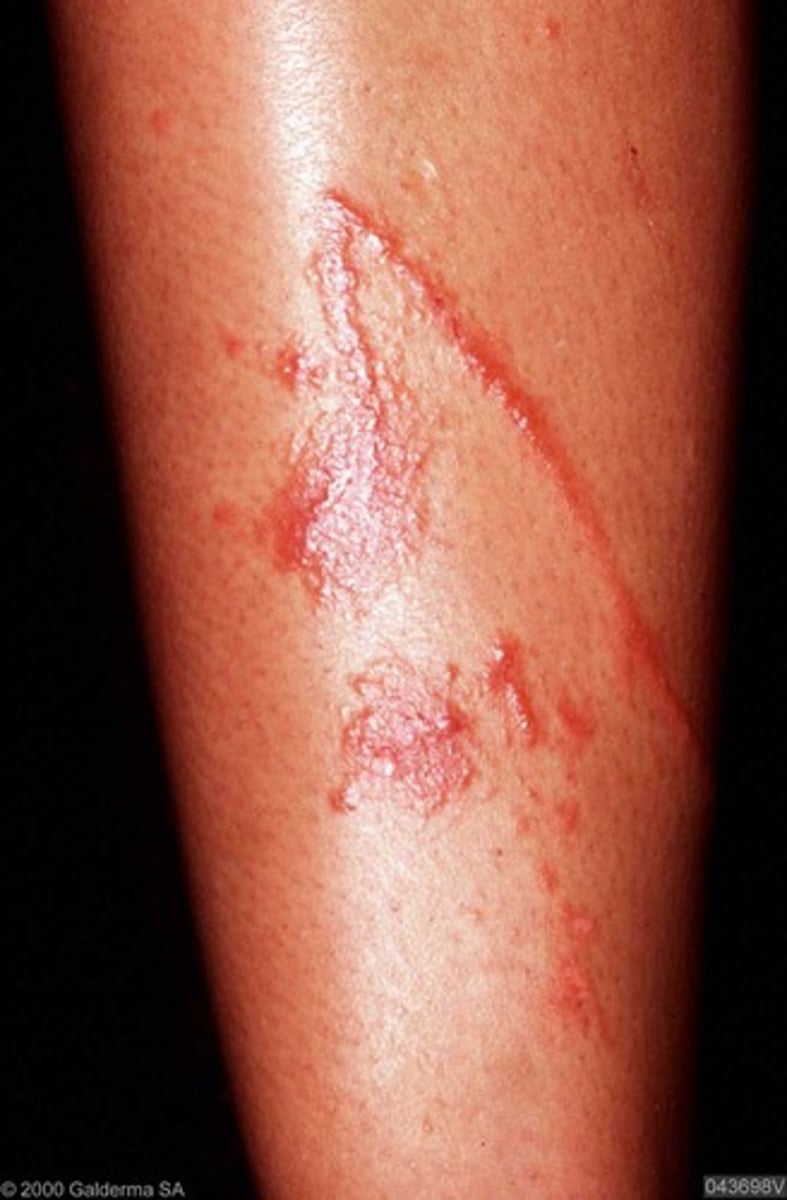 <p>caused by exposure to and direct skin contact with an allergen</p>