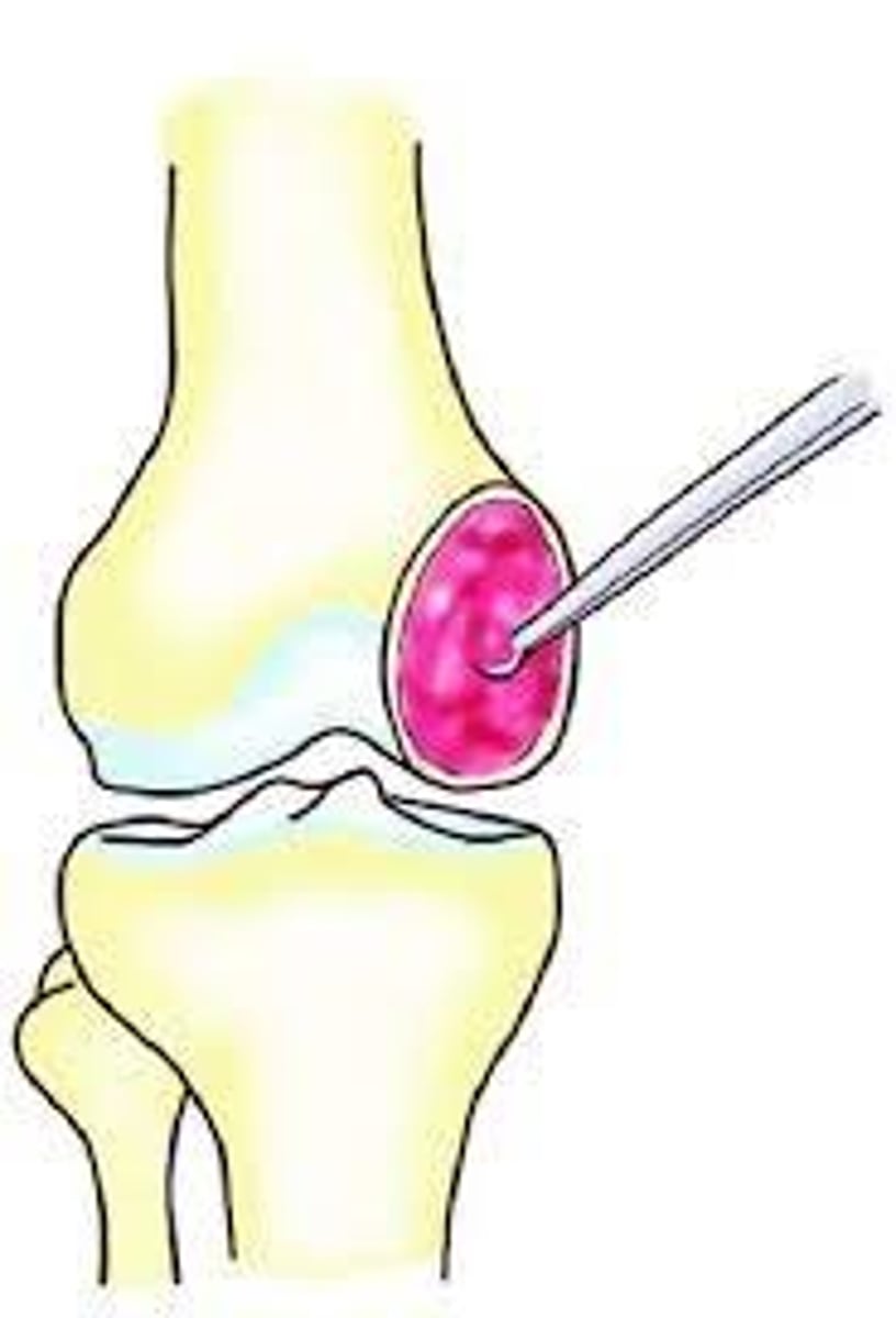 <p>By curettage </p><p>- However, around 40-60% recur locally </p>