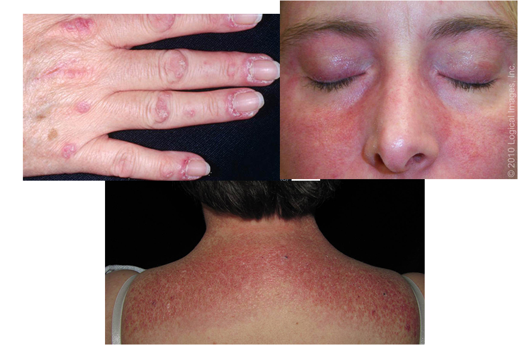 <ul><li><p>progressive, symmetric <strong>proximal muscle weakness</strong> </p></li><li><p><strong>gottrons papules:</strong> pink violaceous papules overlying interphalangeal and metacarpophalangeal joints</p></li><li><p><strong>heliotrope eruption</strong>: pink violaceous erythema, ± edema, involving periorbital skin</p></li><li><p><strong>shawl sign</strong>: confluent, violaceous erythema on posterior neck, upper back, and shoulders</p></li><li><p>rash is photosensitive</p></li></ul><p></p>