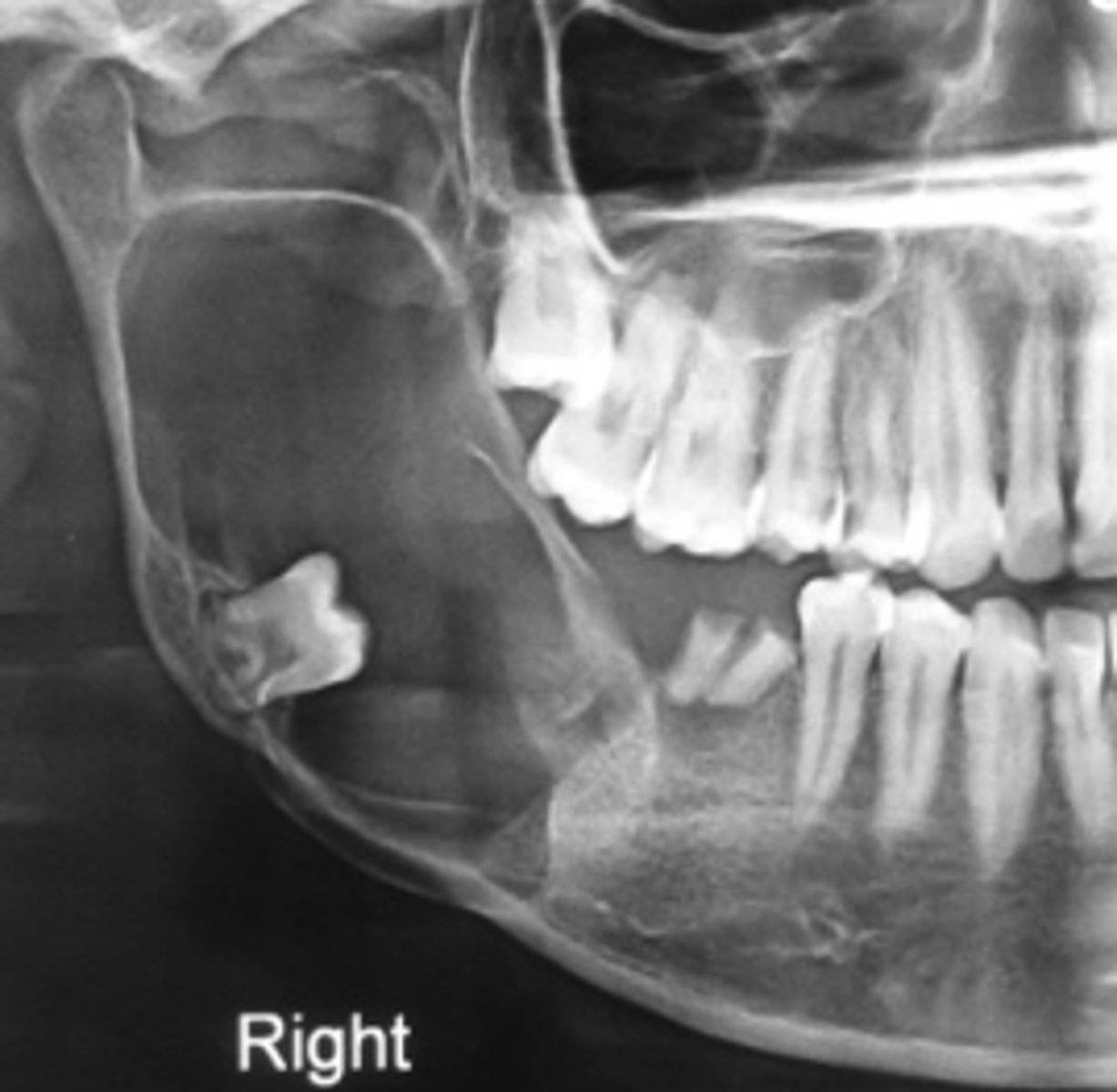 <p>40 y/o patient presents with a well defined, corticated, uni-locular, peri-coronal lesion that displaces #32 on the posterior mandible. Thinning and expansion of the border of the mandible is evident and it displaces the IAN inferiorly. What pathologies are included in your differential diagnosis?</p>