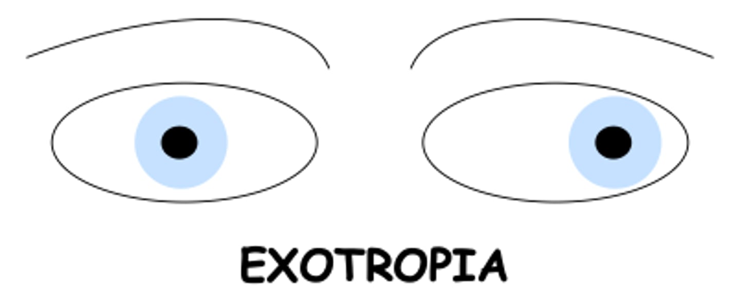 <p>one or both eyes turn outward</p>