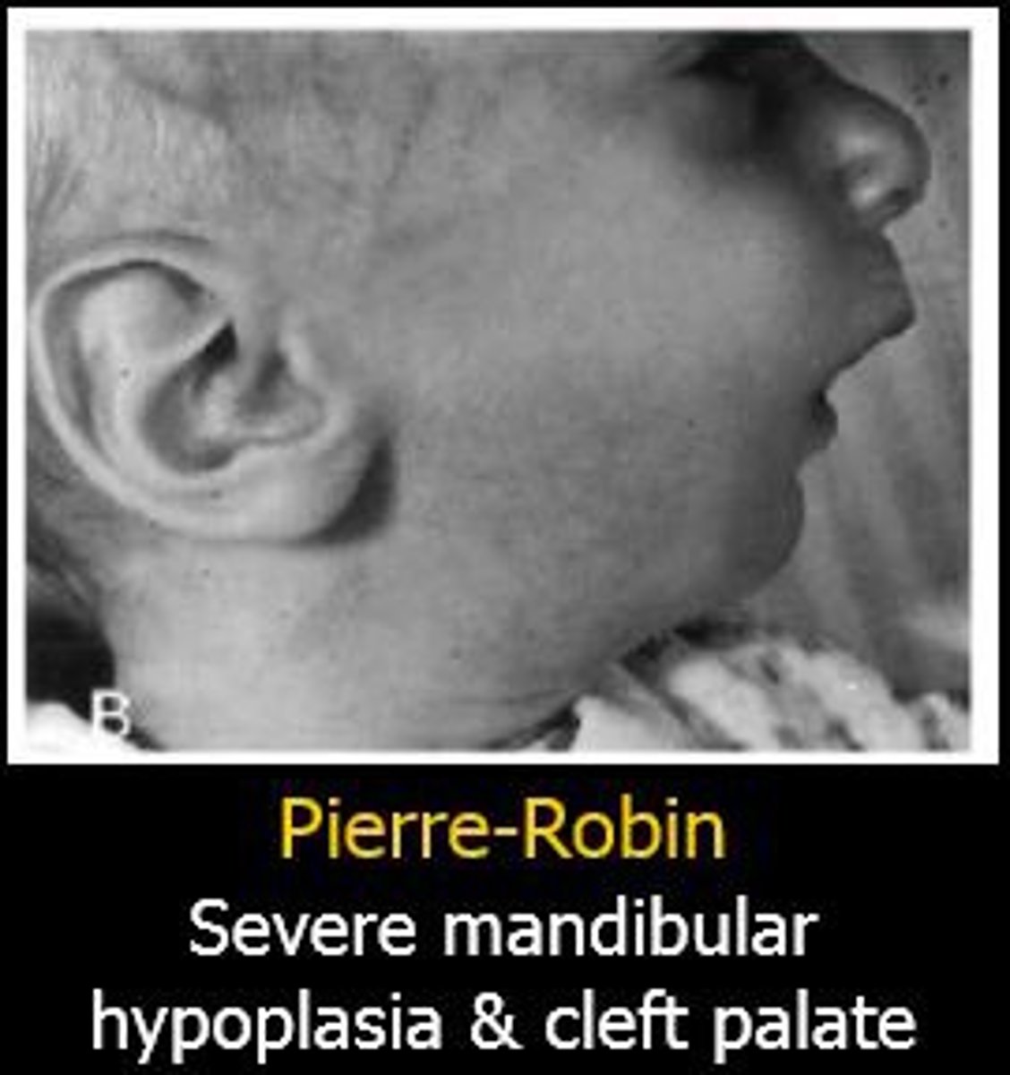 <p>Pierre robin syndrome</p>