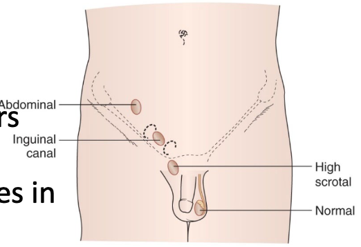 <ul><li><p>“Hidden testes” – a <strong>testis that is not within the scrotum</strong>, or does not descend spontaneously by 4 months of age</p><ul><li><p class="p2">Testis may be undescended, absent, or ectopic</p></li><li><p class="p2">Can be unilateral or bilateral</p></li><li><p class="p2">Incidence ~1% in male infants at 1 year of age</p></li></ul></li></ul><p></p>