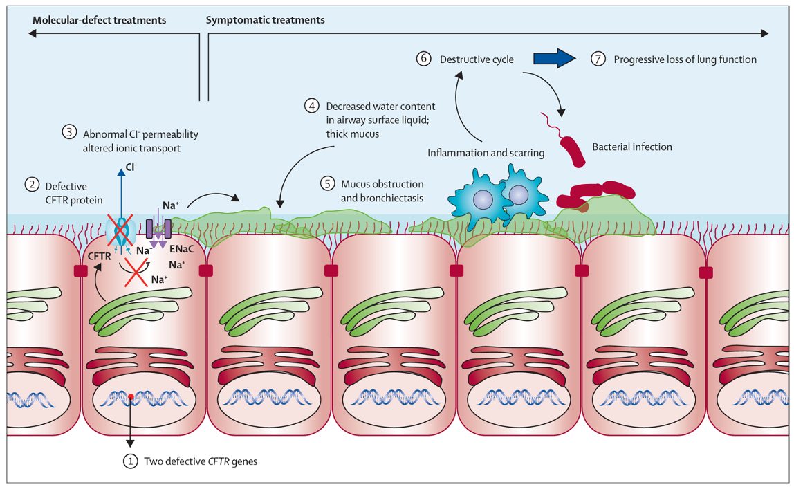 <ul><li><p>defective or absent CFTR → reduces Cl<sup>-</sup> secretion</p></li><li><p>altered ion balance disrupts osmotic water movement</p></li><li><p>mucus becomes dehydrated and viscous </p></li><li><p>thick mucus traps bacteria → persistent infection and inflammation</p></li></ul><p></p>