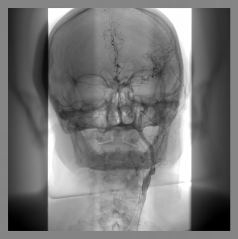<p>background images are obtained before the contrast agent is injected. The background images are then “subtracted” from the images obtained after the injection of the contrast agent. This technique improves image resolution.</p>