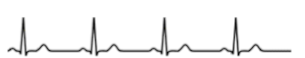 <p>ECG - What is tthis?</p>