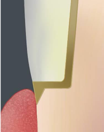 <p><span>Thought to provide internal support of</span><br><span>shoulder margin</span></p>