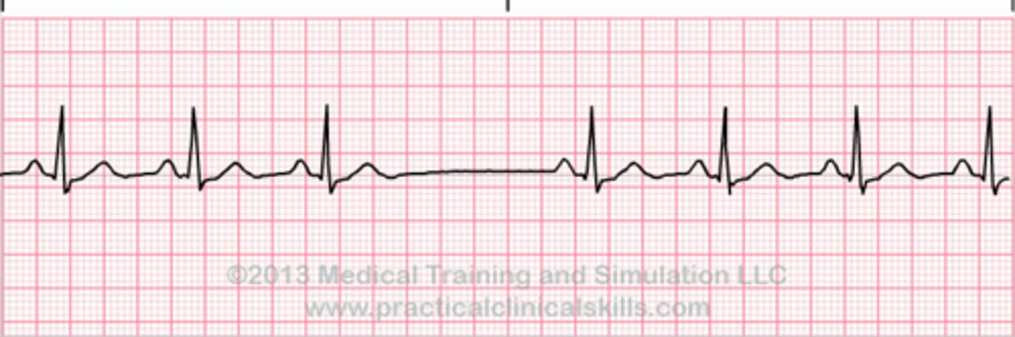 <p>SA node stops firing for at least one cycle, followed by the resumption of normal sinus rhythm or an escape beat</p>