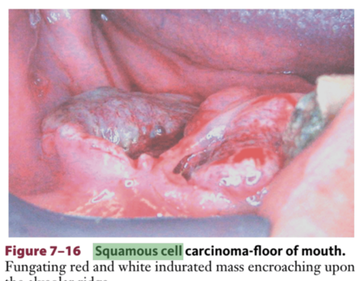 <p>malignant transformation</p><p>of the squamous epithelium lining of the oral cavity</p><p>carcinomas: malignant tumors arising from cells that originated</p><p>from embryonic ectoderm</p>