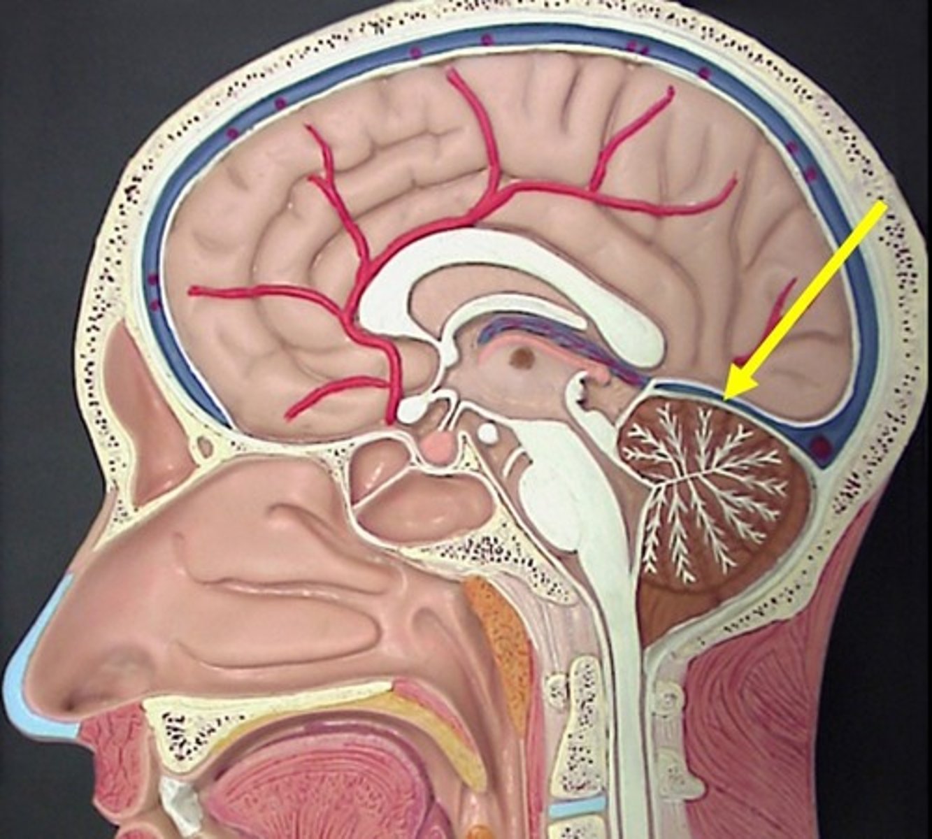 <p>junction of falx cerebri and tentorum cerebelli</p>