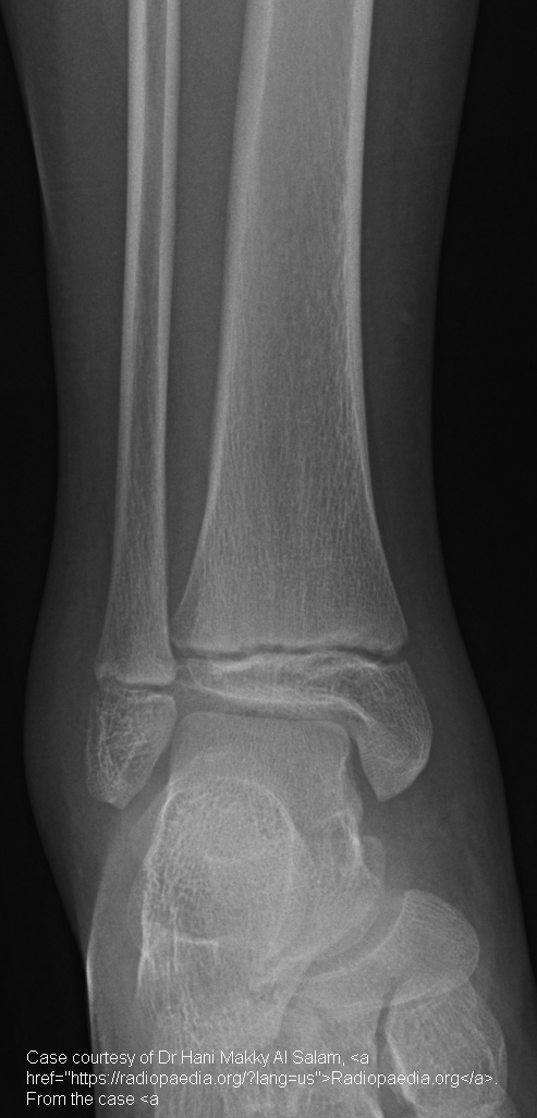 <p>Fracture through the growth plate and metaphysis, creating a triangular metaphyseal fragment.</p>