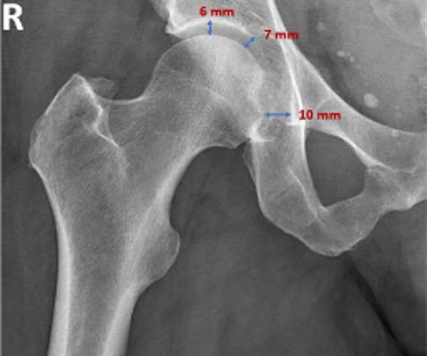 <p>What are the osseous landmarks for this assessment?</p>