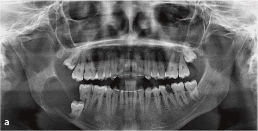 <p>A 25 year old patient present with mild swelling of lower jaw. Intra orally a small swelling was visible over right third molar region. A radiograph taken. Provide Differential diagnosis</p>