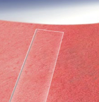 <p>what type of lesion is depicted and what area does it cover</p>