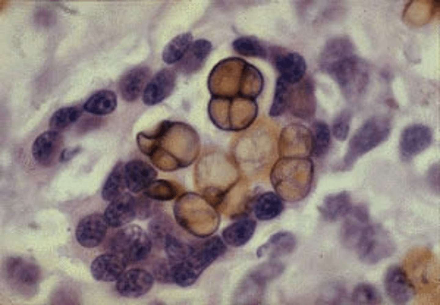 <p>The segmented, dark-staining grains seen in this photomicrograph are most commonly seen in cases of chromoblastomycosis. Which fungal species is known to cause this disease?</p>