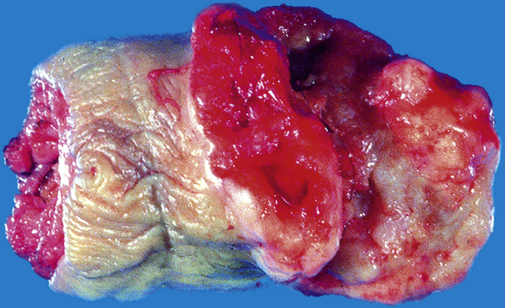  A 56-year-old man from Fortaleza, Brazil, has noted

increasing size of a penile lesion for the past 18 months. Physical examination reveals the appearance shown in the figure, following resection. What is most likely to be seen on microscopic examination? 

\
