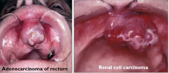 <p>If metastatic disease does occur, where will it be?</p>