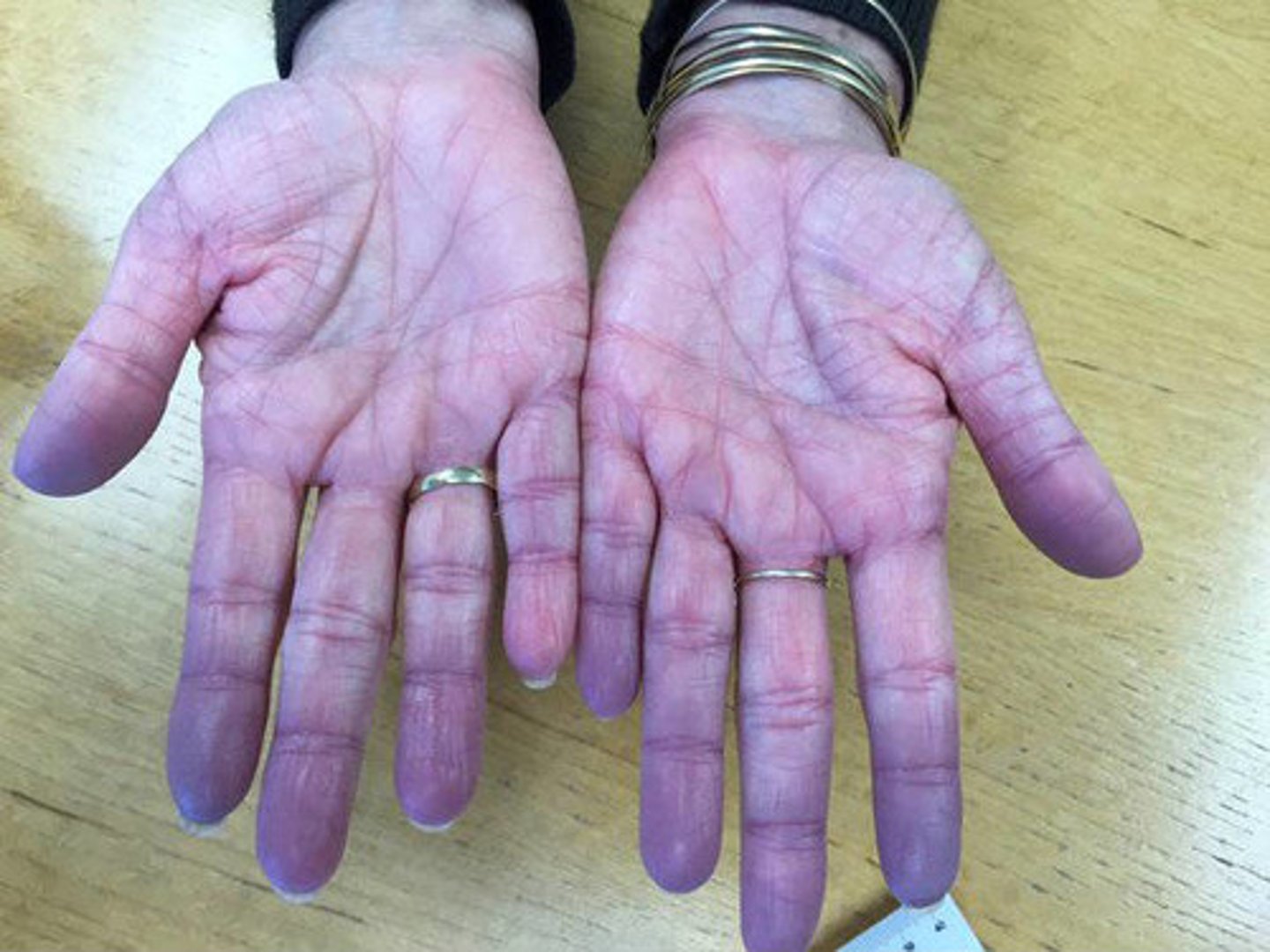 <p>Cyanosis</p>
