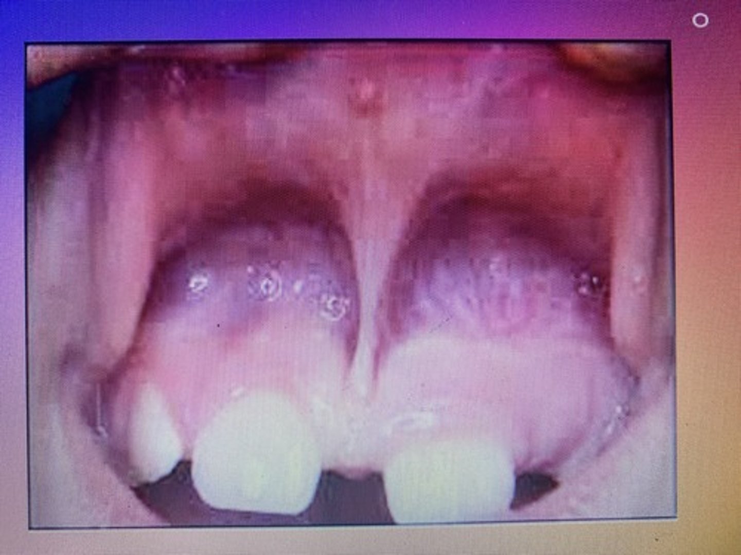 <p>Low maxillary frenulum attachment (this may cause a diastema or "gap" between #8-9 if it is not corrected in early childhood)</p>