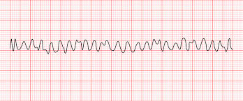 <p>Rhythm Interpretation</p>