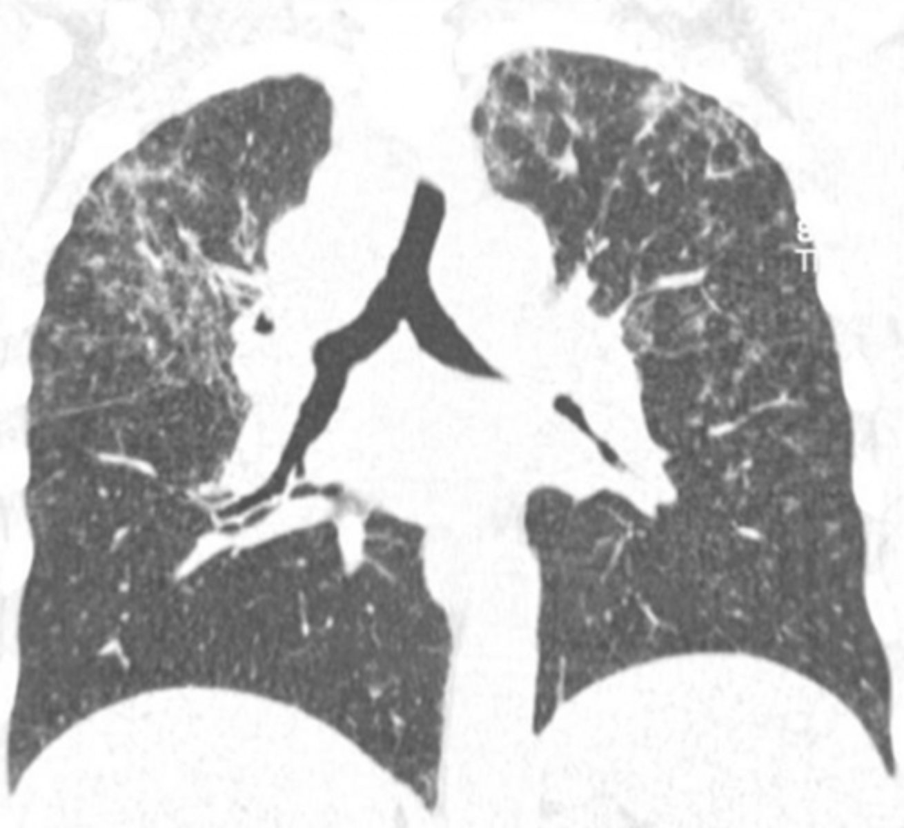 <p>Mediastinal / bilateral hilar lymphadenopathy</p>