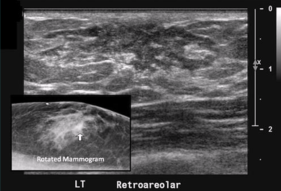 <p><span>enlargement of breast tissue in men</span></p>