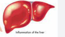 <p><span style="font-family: Droid Sans Mono, monospace">VIRAL HEPATITIS</span></p>