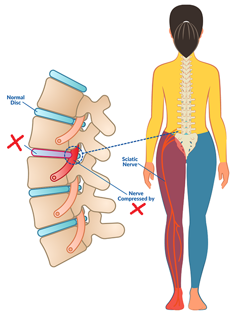 protrusion of a fragmented intervertebral disc in the intervertebral foramen, may be painful if due to pinched nerve
