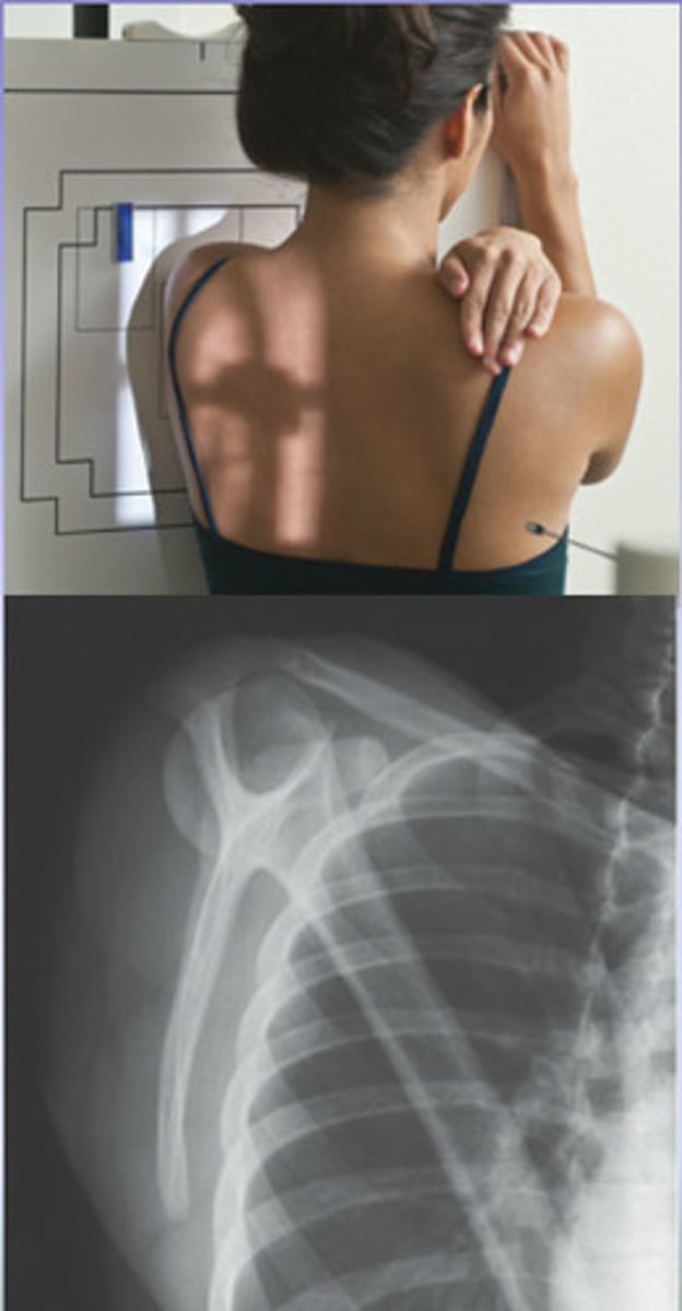 <p>patient in 45° anterior oblique, cross affected arm onto shoulder to remove humerus from scapular body</p>