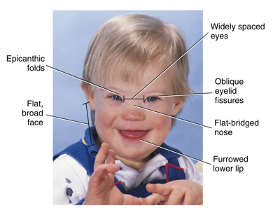 <ul><li><p>also known as trisomy 21</p></li><li><p>An extra chromosome number 21 is present after meiotic division</p></li><li><p>characterized by epicanthic folds, oblique eyelid fissures, flat-bridged nose, furrowed lower lip, widely-spaced eyes, and a flat broad face </p></li><li><p>increased levels of periodontal disease, delayed tooth eruption, fewer teeth present, microdontia, and increased risk of alzheimer’s disease </p></li></ul><p></p>