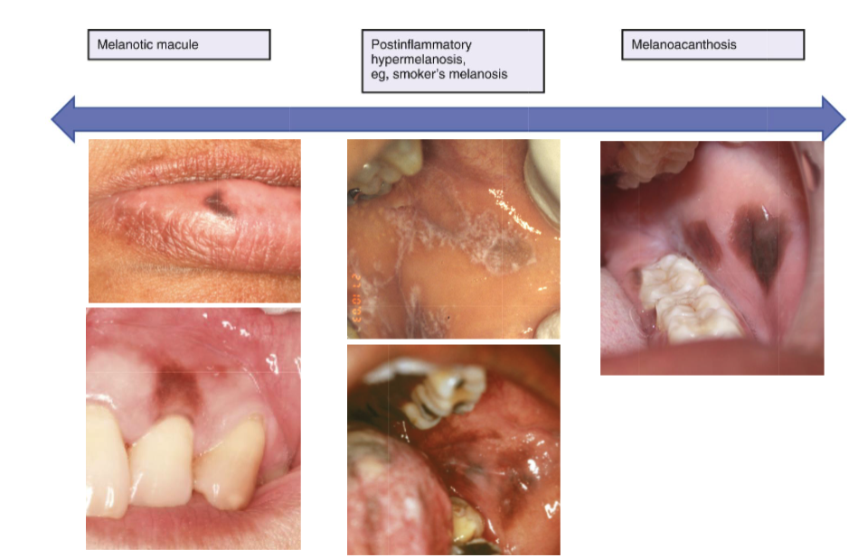 <ol><li><p>oral melanotic macule</p></li><li><p>post-inflammatory hypermelanosis (Smoker’s melanosis) </p></li><li><p>melanoacanthosis</p></li></ol><p></p>