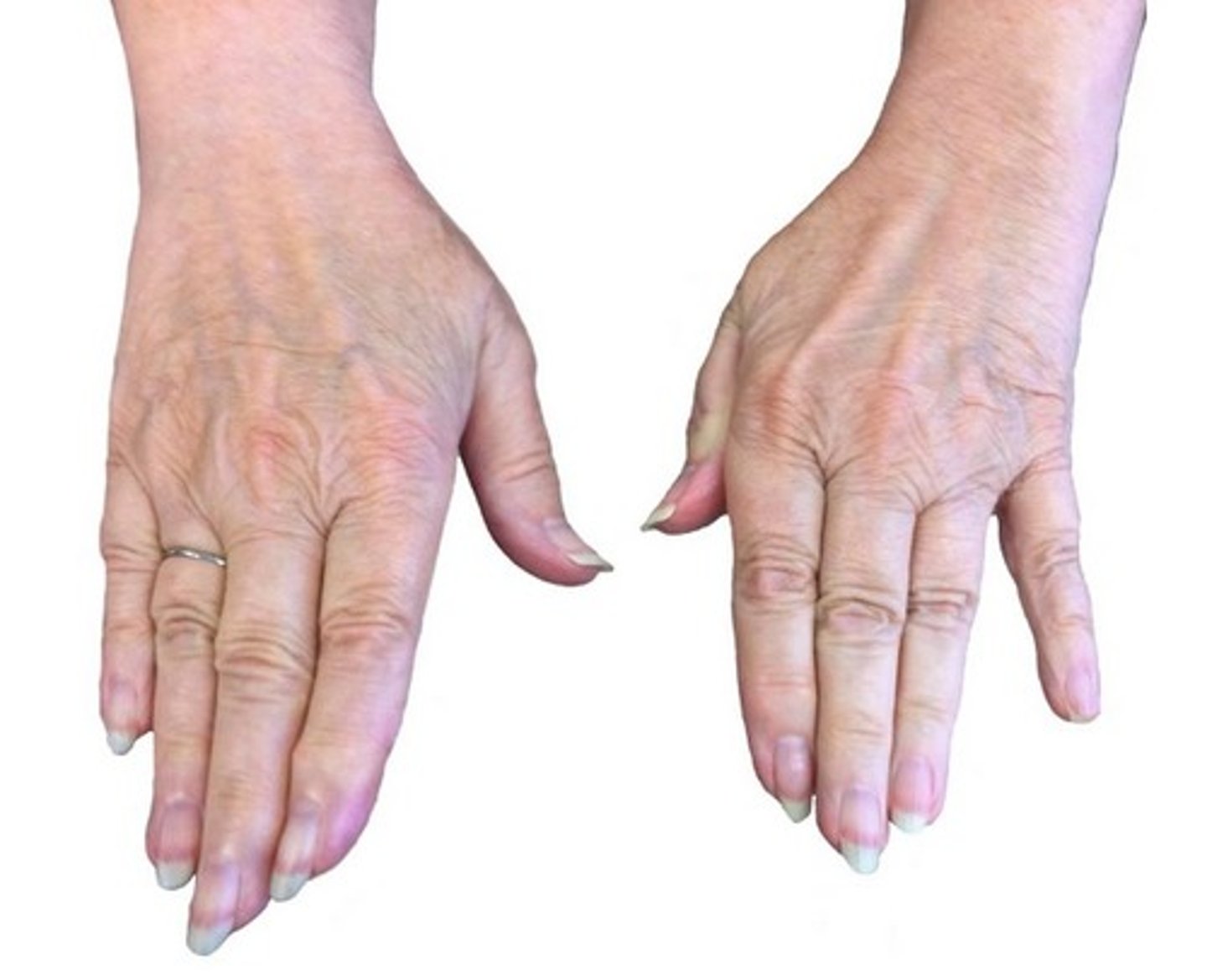 <p>Unable to adduct pinky, resting in abduction</p><p>Associated with a laceration to the ulnar nerve</p>