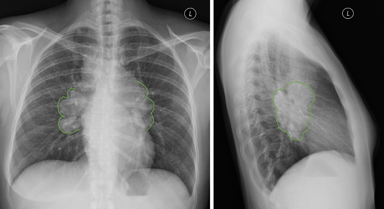 <p>Patient history: chronic fatigue and weight loss in a 39-year-old patient </p><p>Modality: left – PA chest radiograph right – left lateral chest radiograph </p><p>Region: chest, lungs Radiologic sign: bilateral hilar enlargement (green area), middle mediastinal mass, no alteration in lung parenchyma </p><p>Diagnosis: bilateral hilar lymphadenopathy in sarcoidosis (stage 1)</p>