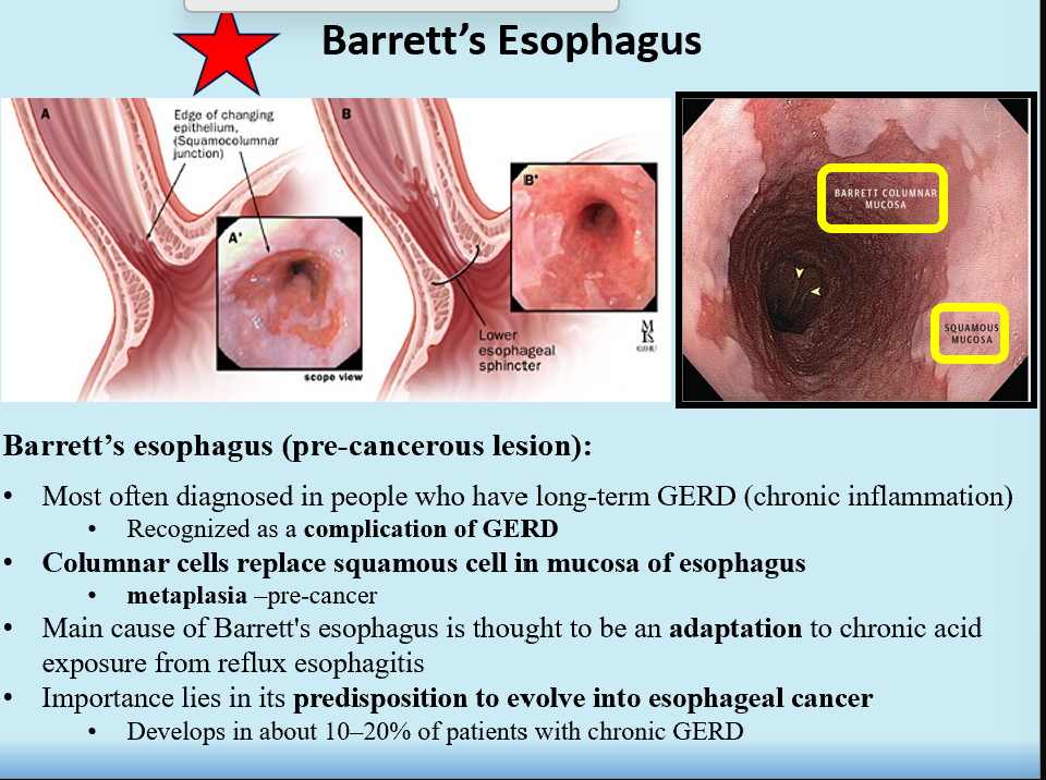 <p>Special type of GERD, a complication of it</p><ul><li><p>An adaptation to chronic acid exposure</p></li></ul><p>AKA pre-cancerous lesion (Metaplasia)</p><p>Columnar cells replace squamous cells in mucosa of esophagus</p><p>Predisposition to esophageal cancer</p>