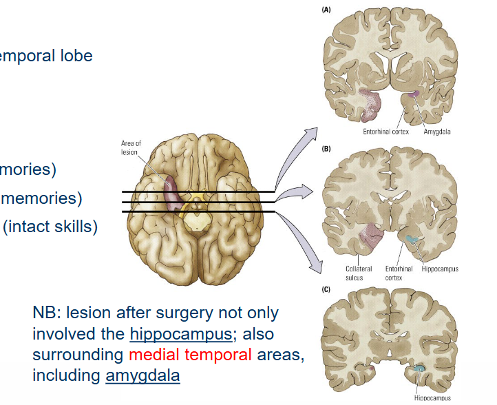<p>His surgery: bilateral <u>hippocampectomy</u>.</p><ul><li><p>Severe <u>anterograde</u> amnesia (no new memories)</p></li><li><p>Little or <u>no</u> retrograde amnesia (intact old memories)</p></li><li><p>Little or <u>no</u> problems with implicit memory (intact skills).</p></li></ul><p></p>