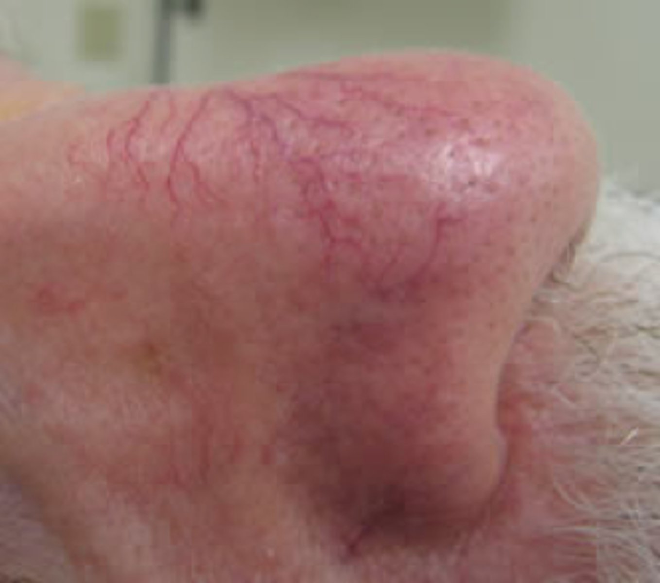 <p>__________________:</p><p>•Small enlarged blood vessels near the surface of the skin</p><p>•Usually mms in size</p><p>•On nose, cheeks &amp; chin</p><p>•</p>