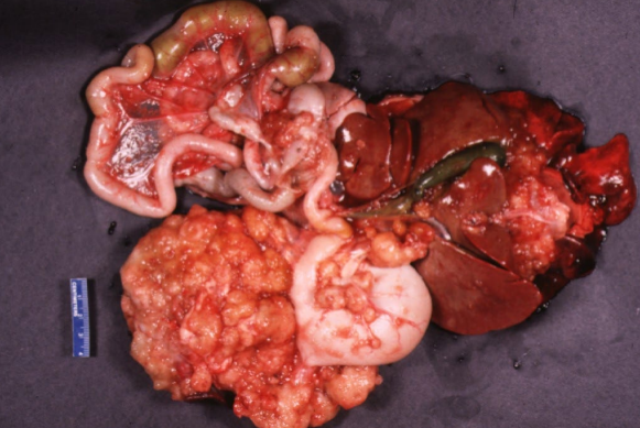 <p>Intra-abdominal contents from a 13-year-old FS, DSH cat with a history of chronic weight loss. Digital imaging revealed a napkin-ring like area of ileal wall thickening (beside the ileocecal junction) with luminal stenosis. A full-thickness biopsy of area of thickening of the ileal wall revealed transmural infiltration of the ileum by neoplastic epithelial cells embedded in fibrous stroma (desmoplasia).  morph?</p>