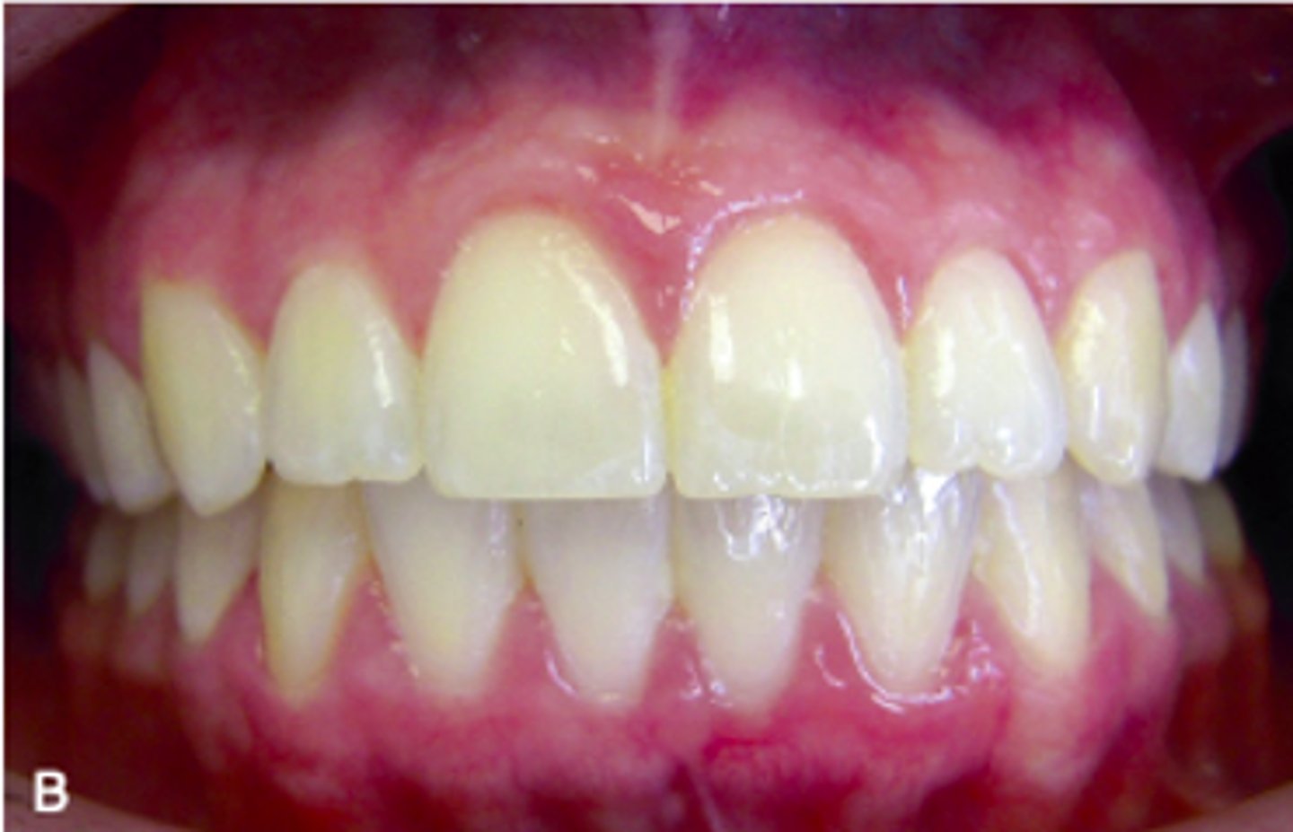 <p>ID the occlusion classification:</p>