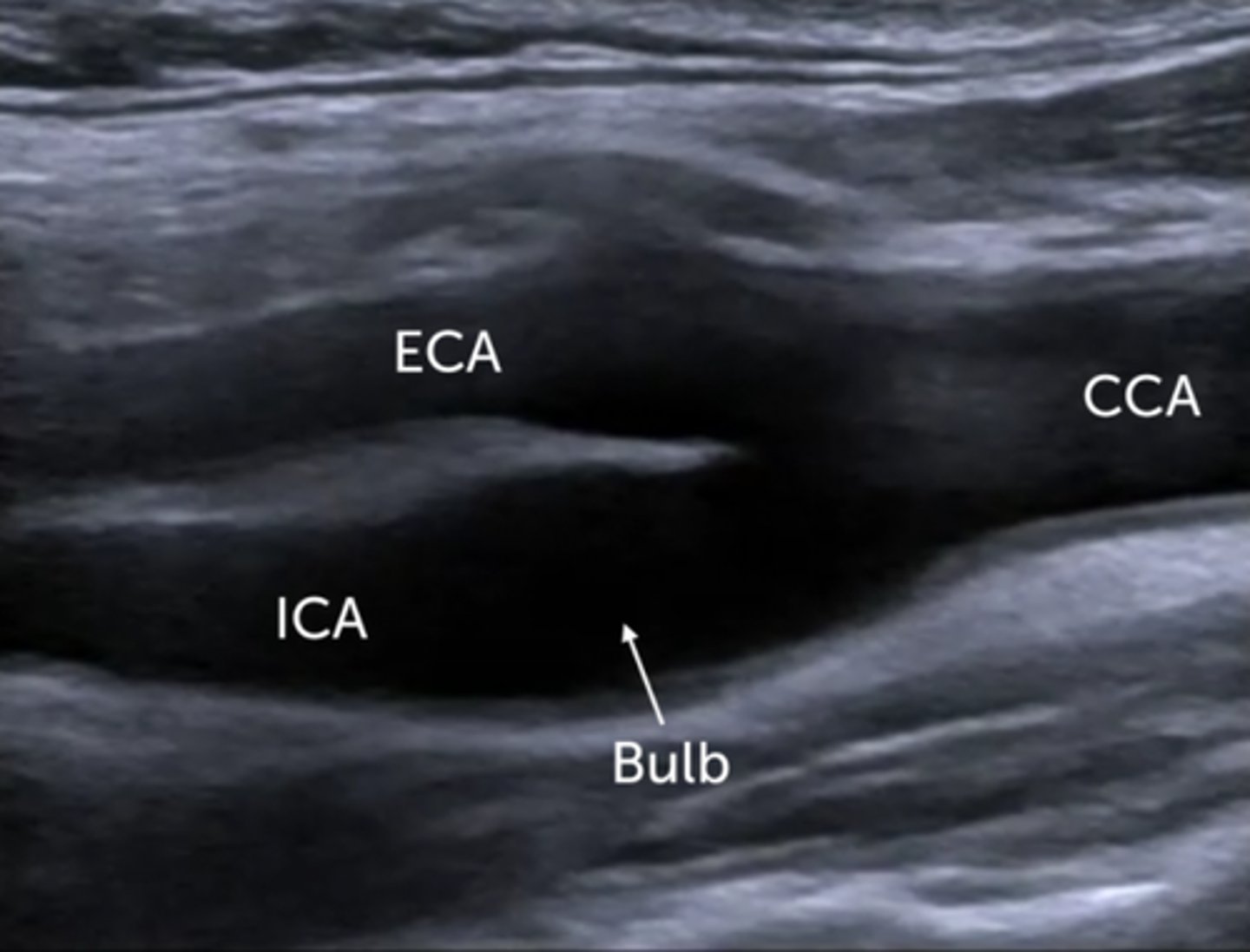 <p>-Supplies the neck, scalp, and face with blood</p><p>-Lies anterior and medial to the ICA</p><p>-Multiple extracranial branches</p><p>-Superior thyroid artery is the first branch of the ECA</p>
